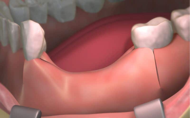 Bone loss after tooth removal