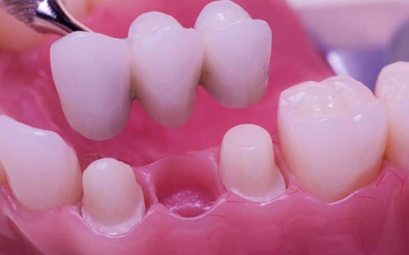 dental bridge functional solution for missing teeth