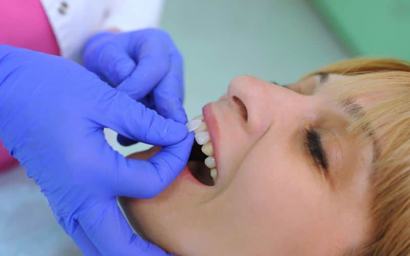 The dentist is applying veneers to the patient's teeth