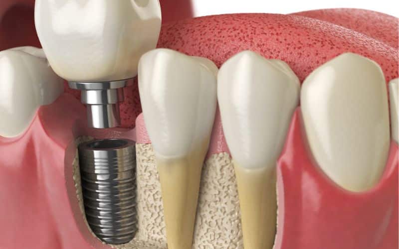 anatomy healthy teeth tooth dental implant