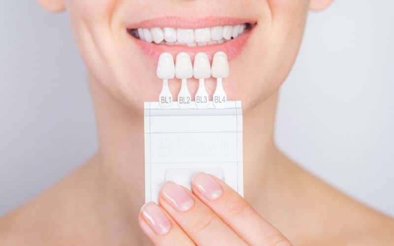 Dental veneers whiten your teeth