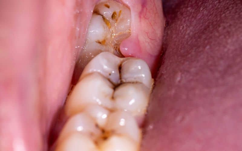 Impacted First Molars wisdom teeth