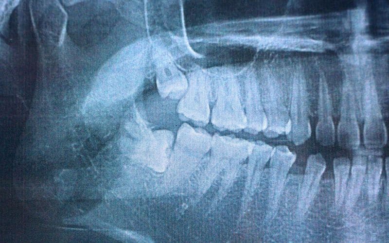 Impacted Third Molars in  x-ray