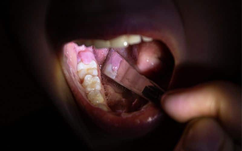 There is a wisdom tooth affected by pericoronitis