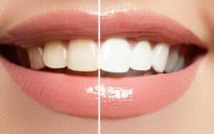 Teeth Whitening hsa