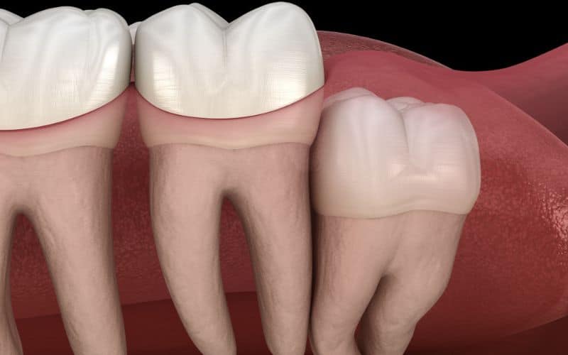  healthy teeth Vertical Impactions wisdom tooth