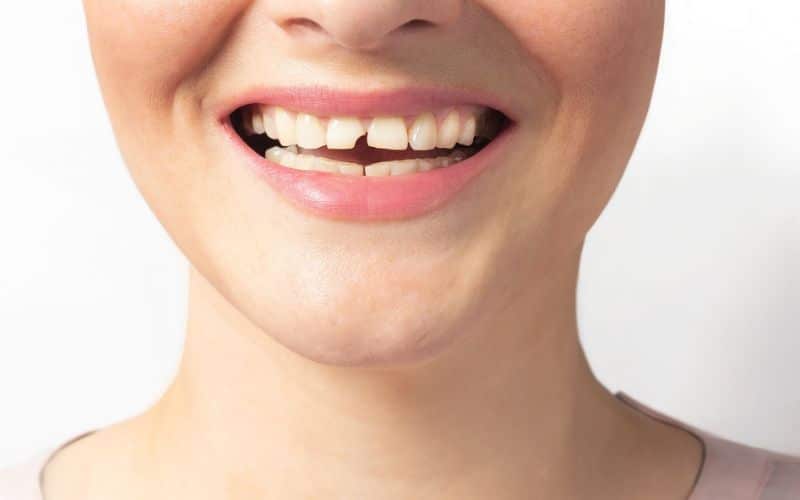 women smile with broken tooth