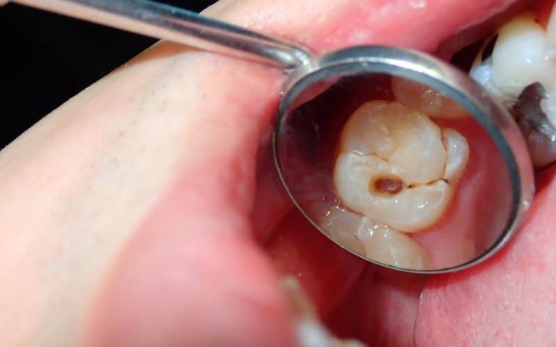 teeth with cavity