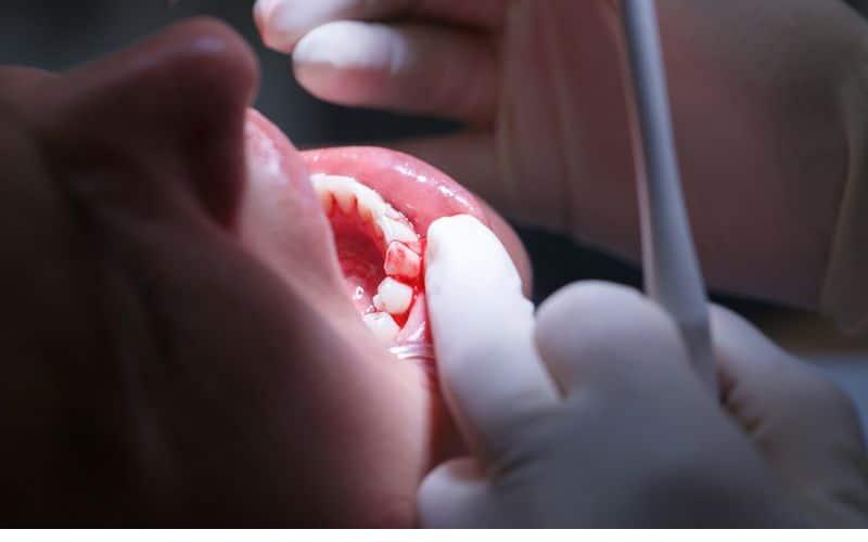
The patient is experiencing bleeding in their gums