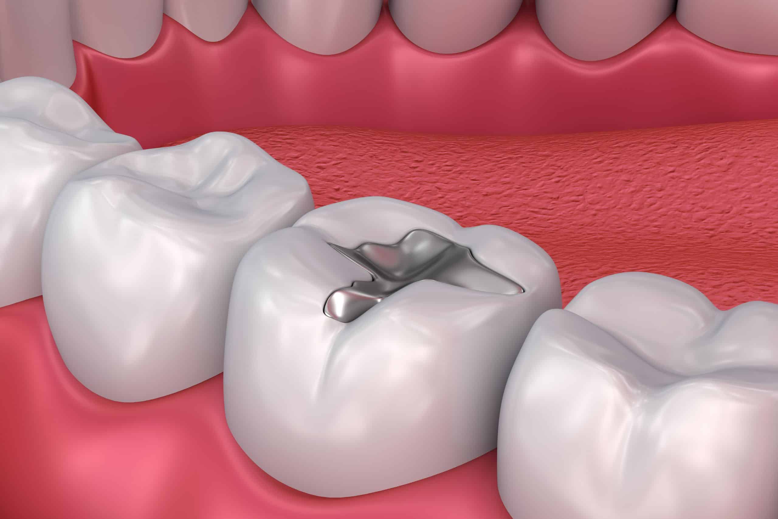 metal dental fillings