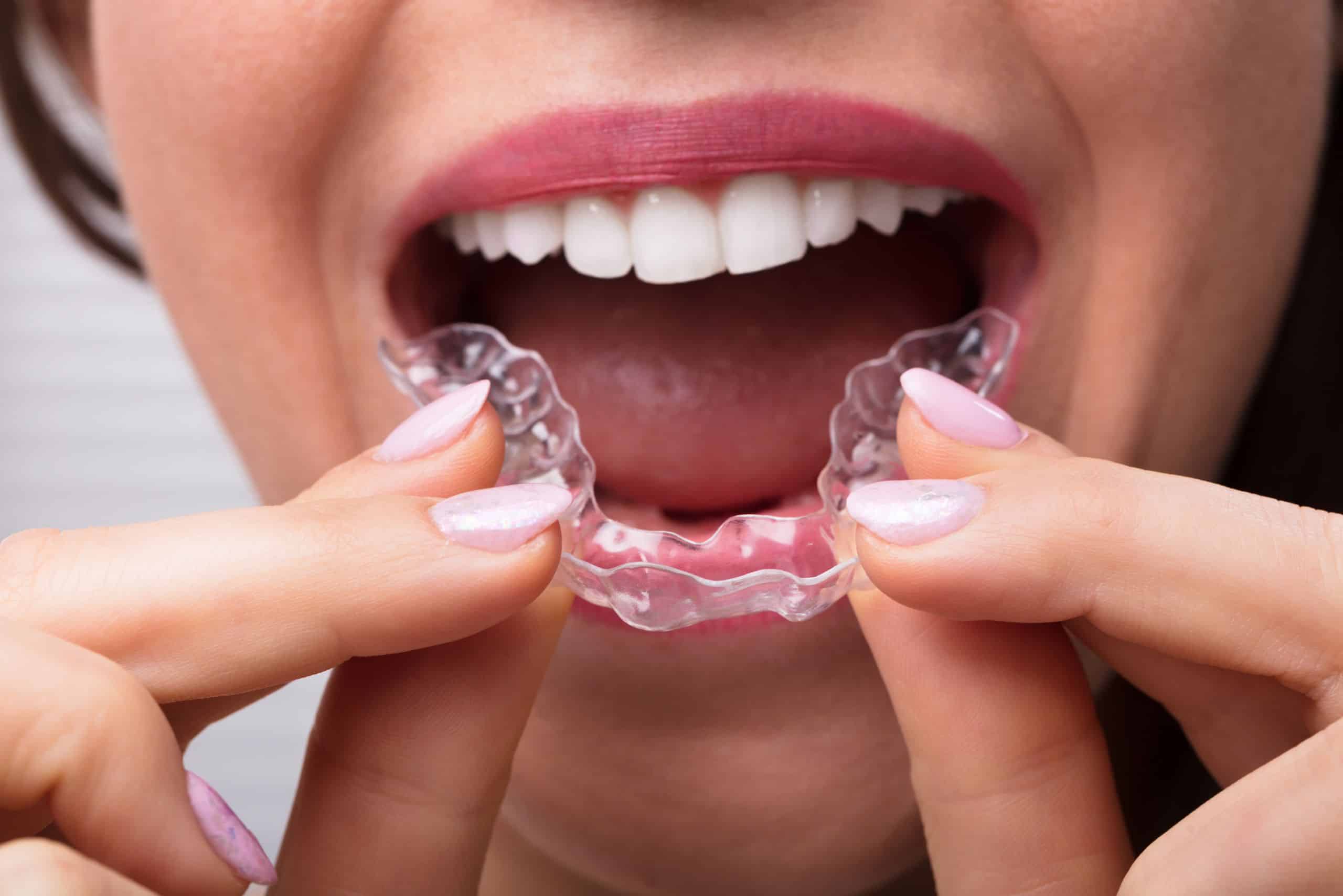 woman hand putting transparent aligner in teeth