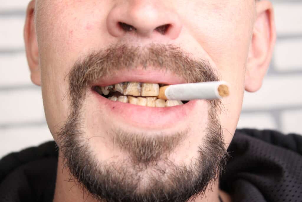 bad teeth smoker