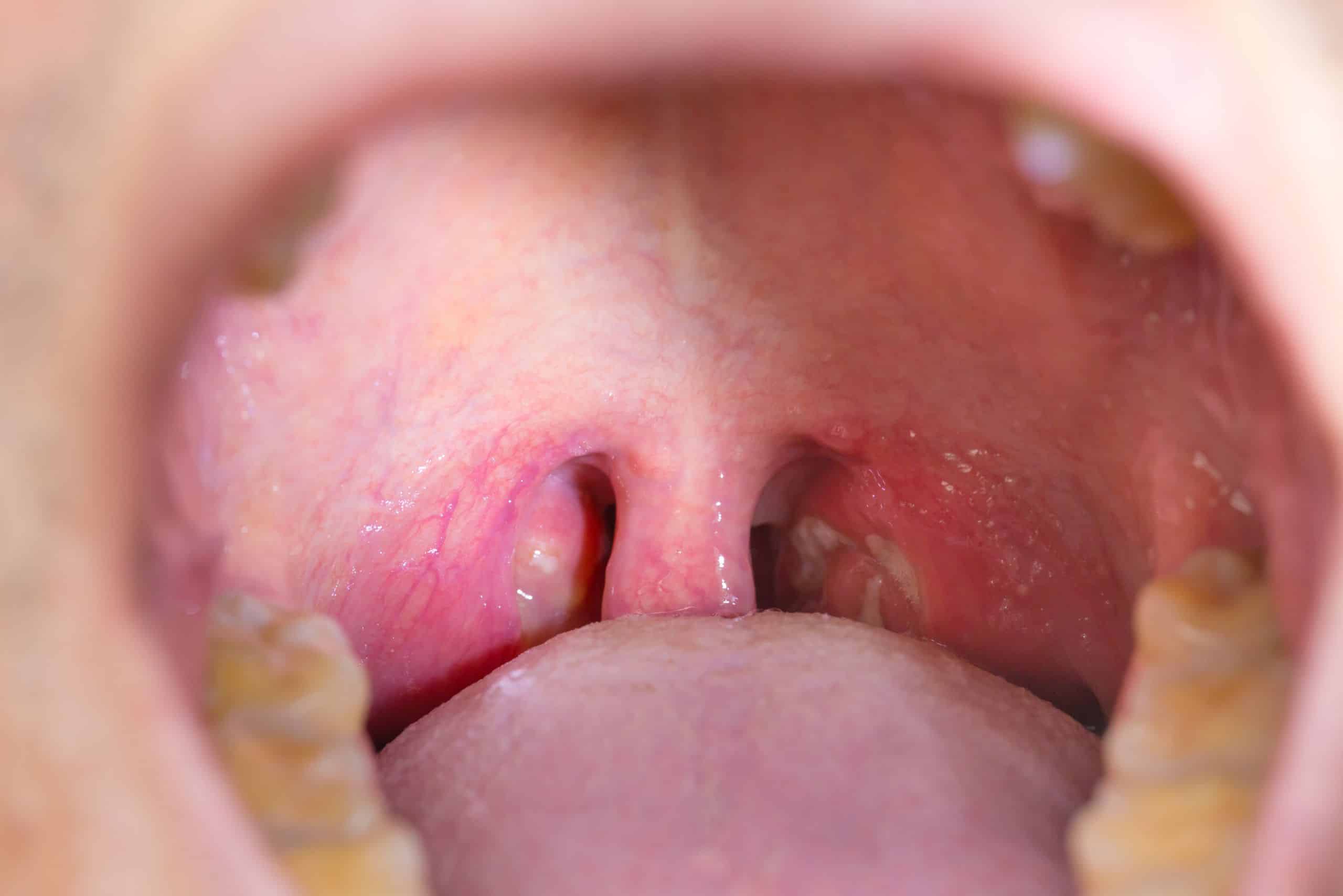 oral tonsil