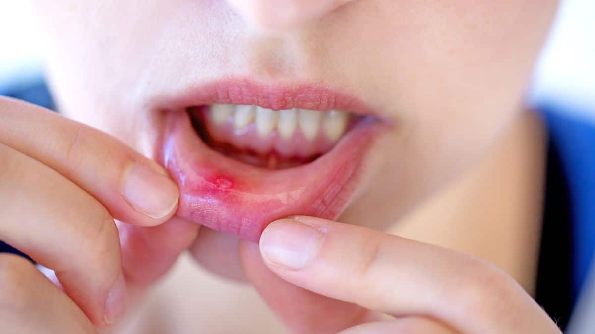 Female showing red and painful canker sore inside her lip