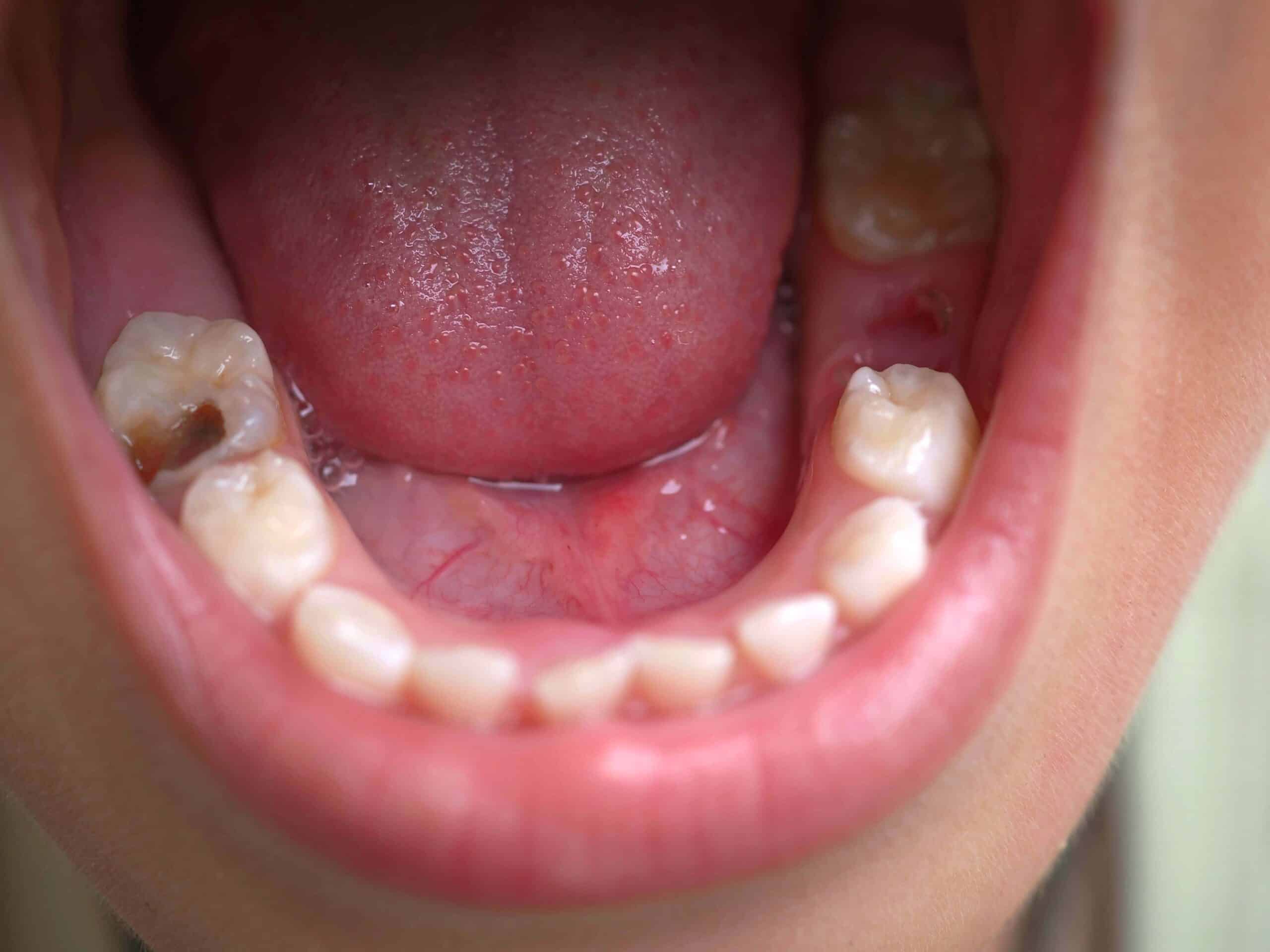 Child patient open mouth showing caries teeth decay