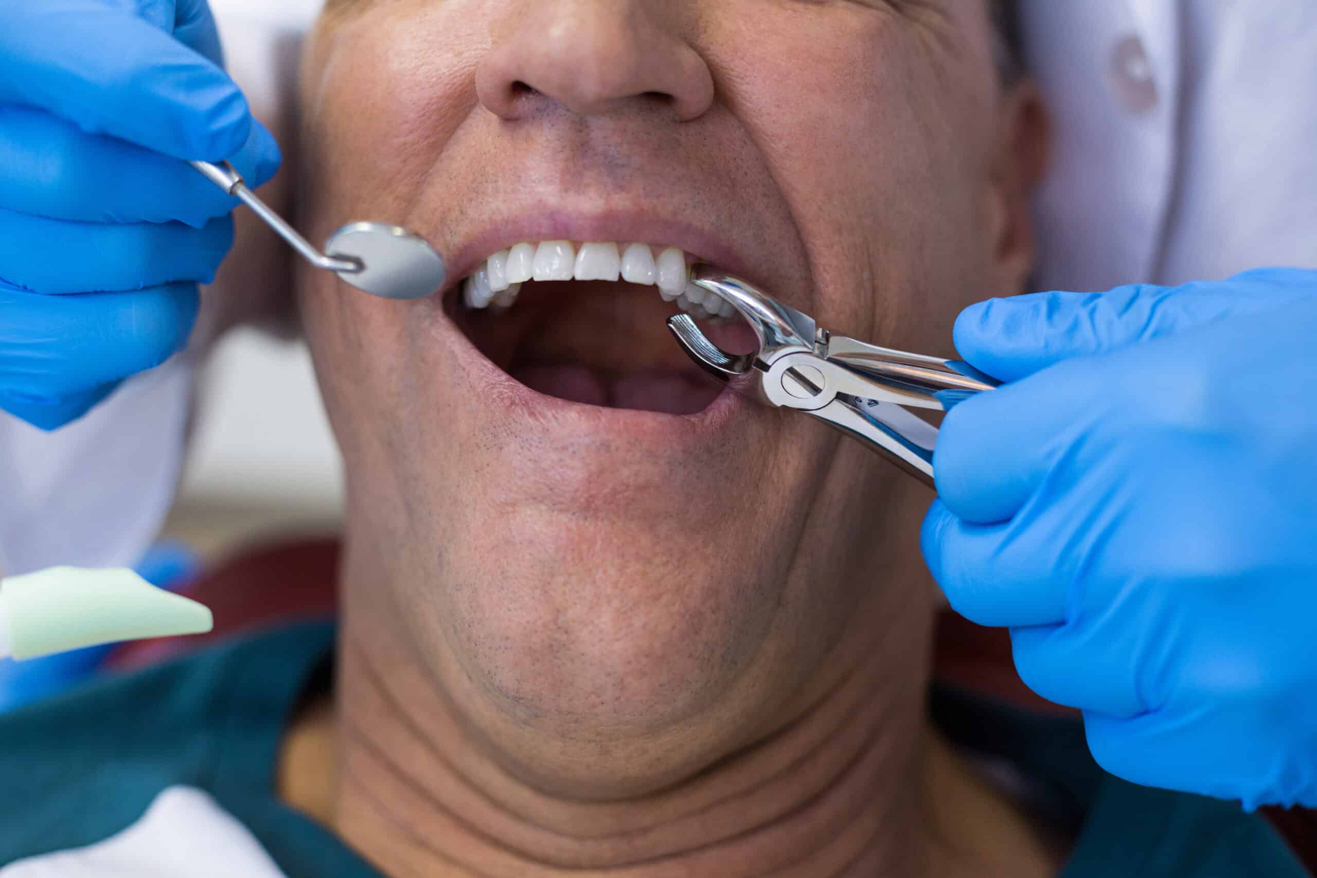 Expert Opinions on Painful-Tooth Extractions