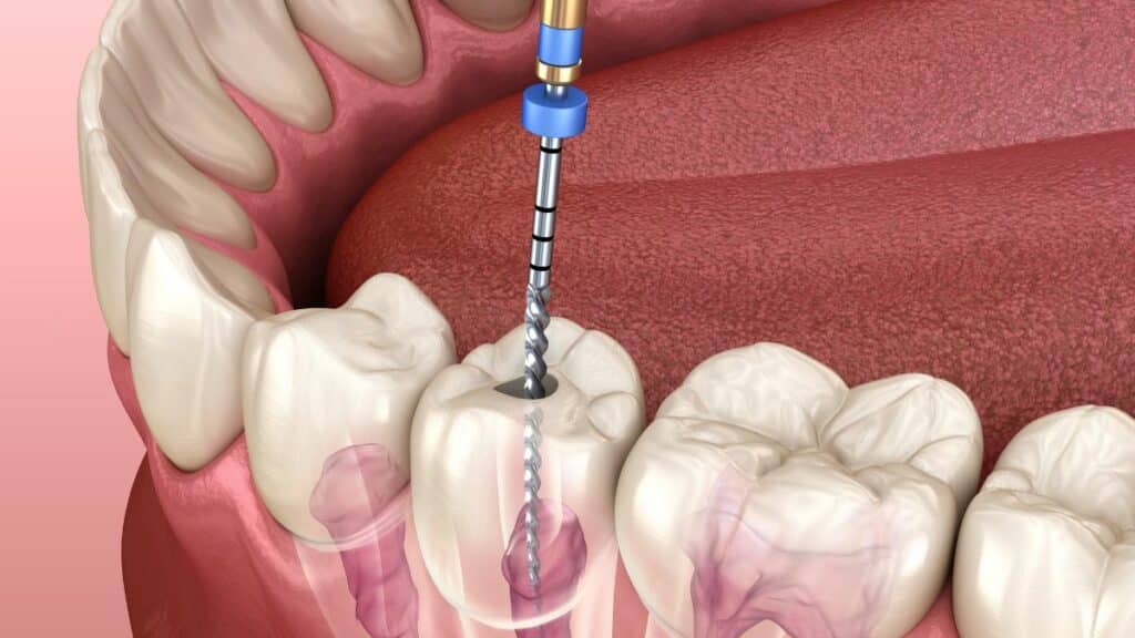 Is it Really Necessary to Get a Root Canal