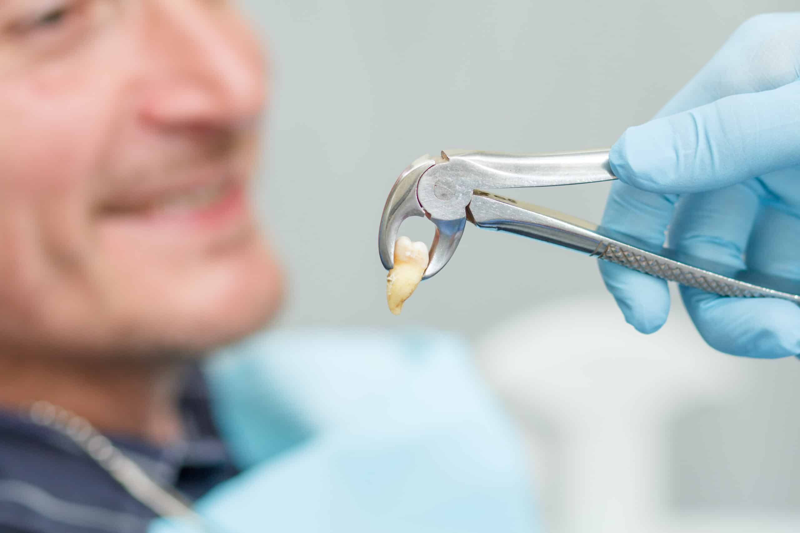 Personal Experiences Tooth Extraction