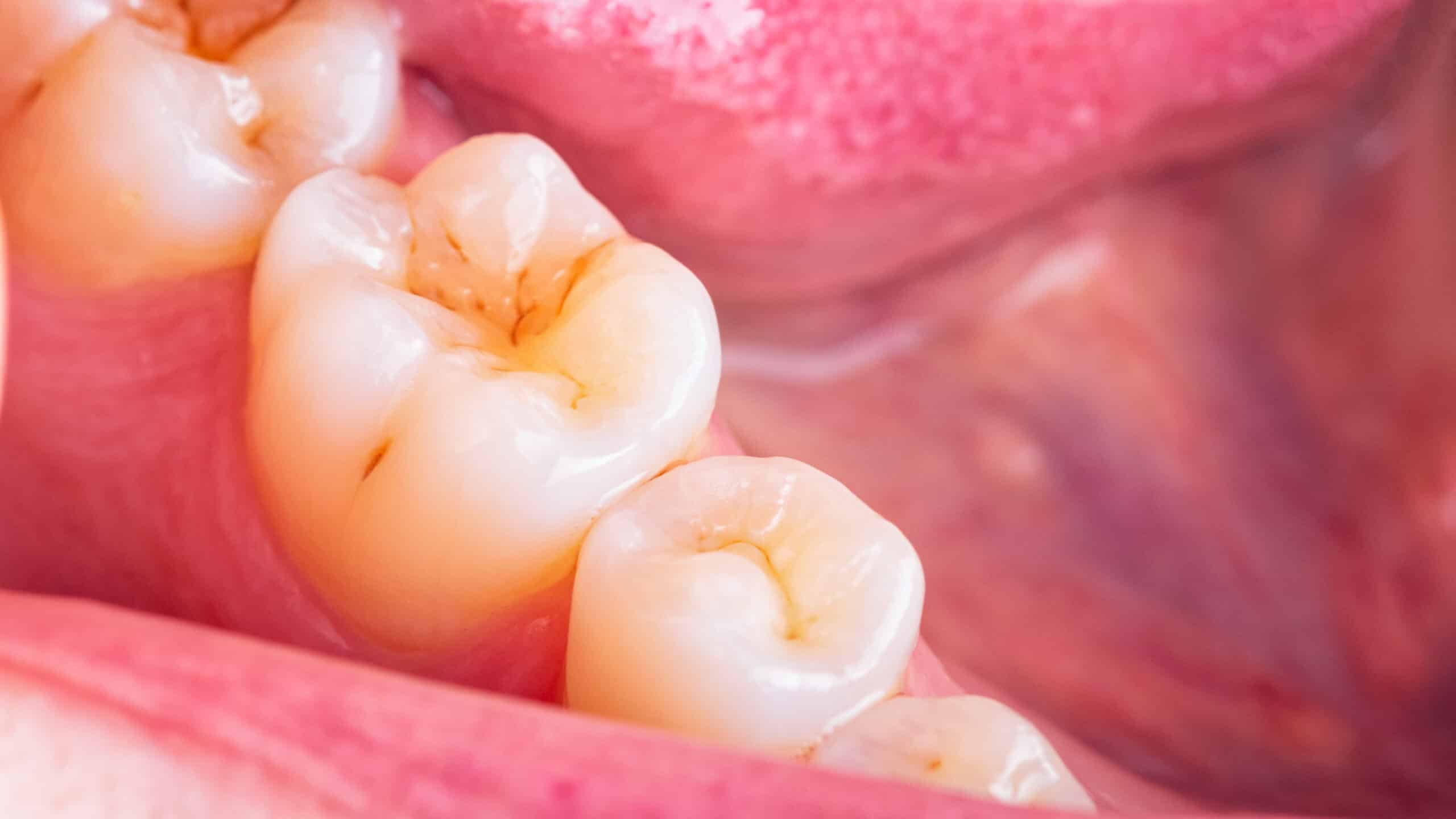 Plaque can harm teeth and cause cavities