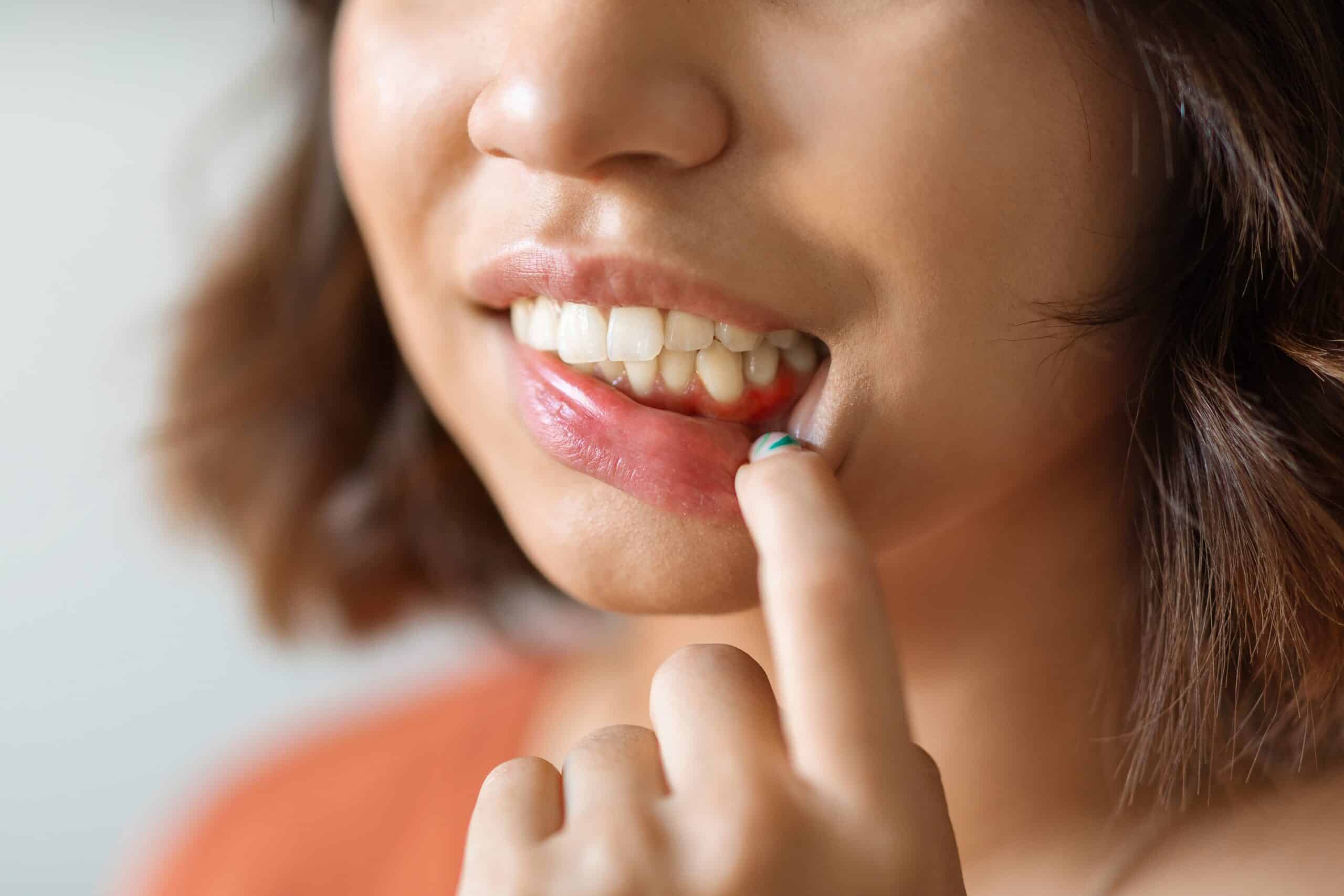  Young Woman Pulling Her Lip And Demonstrating Irritated Gums