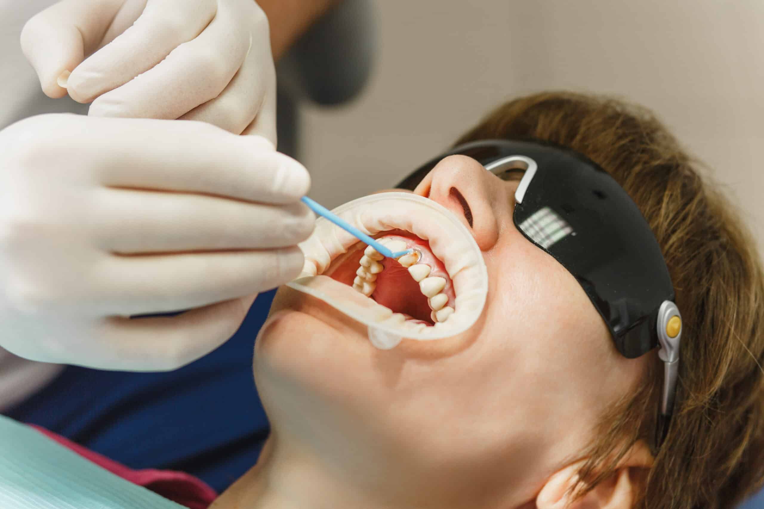  process of preparing and installing dental ceramic crown