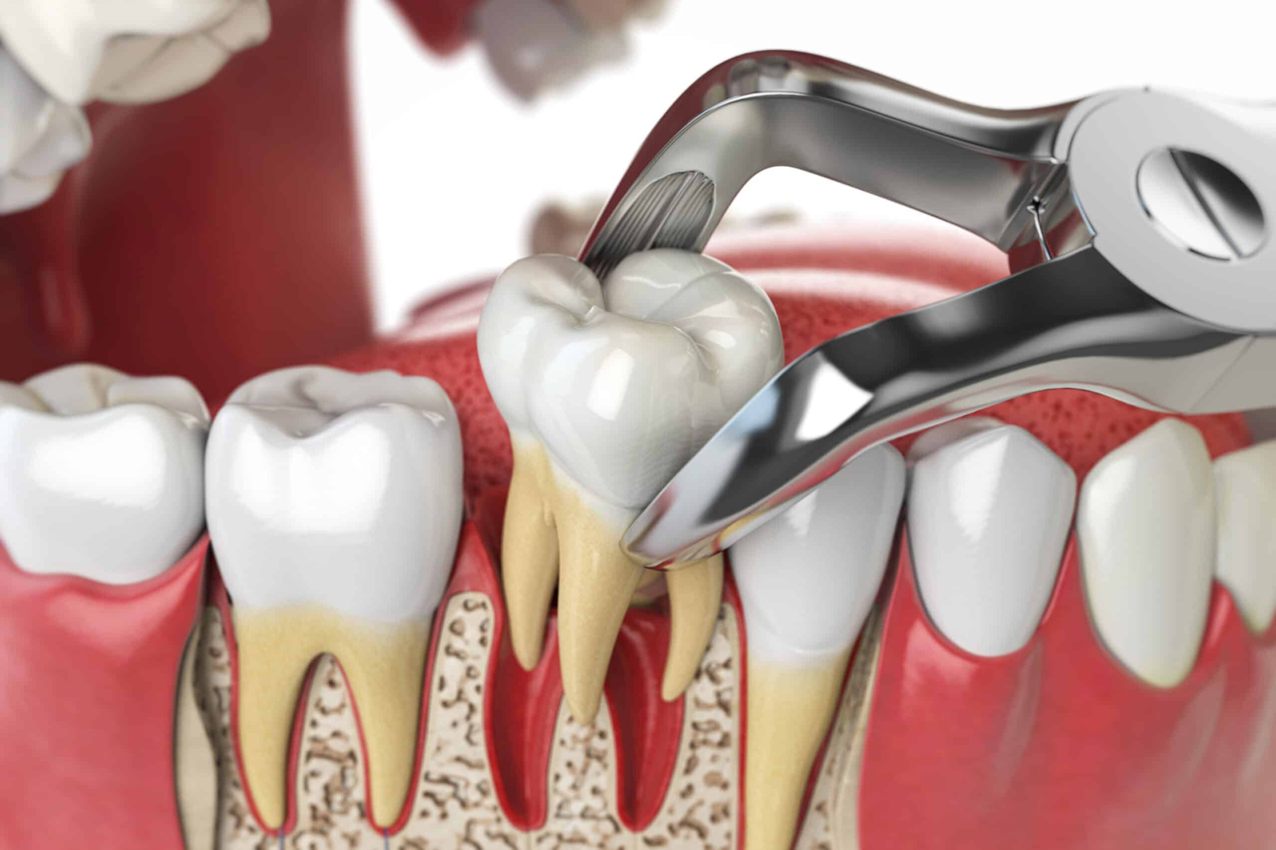 Pros and Cons of Extracting a Painful Tooth
