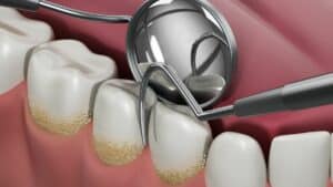 dentist tools and dental plaque