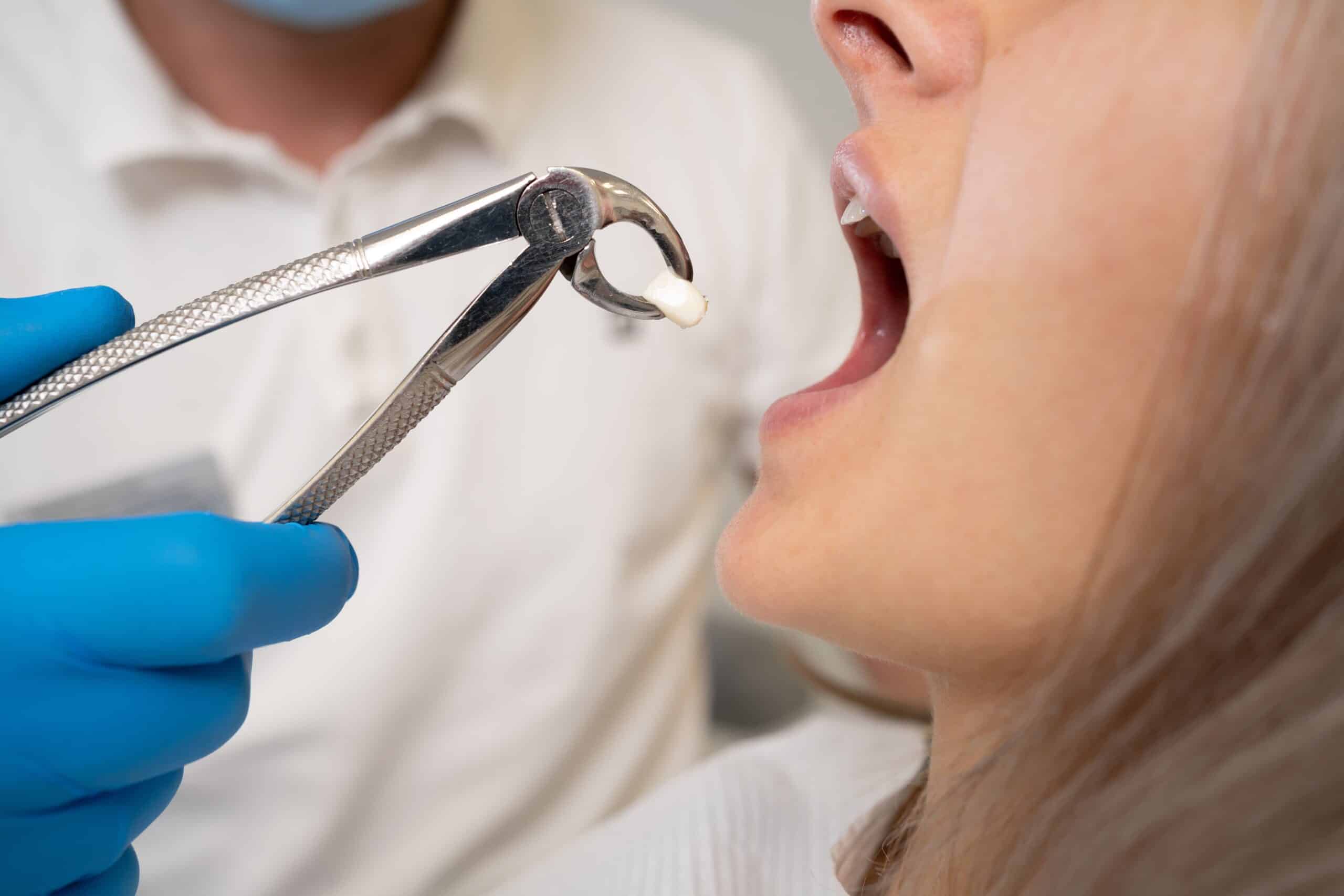 The Link Between Toothache and Extraction