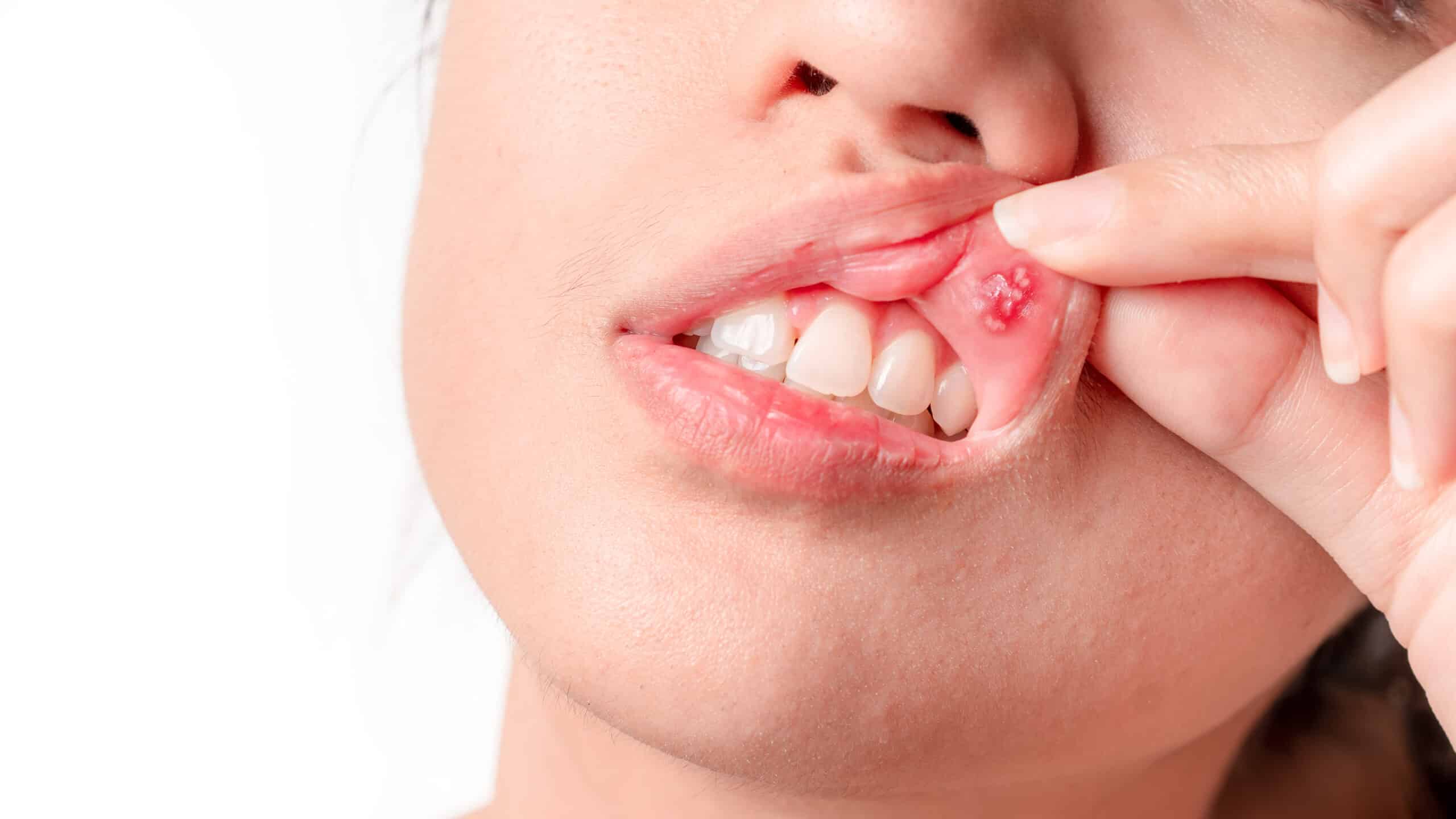 Asian women have aphthous ulcers on mouth