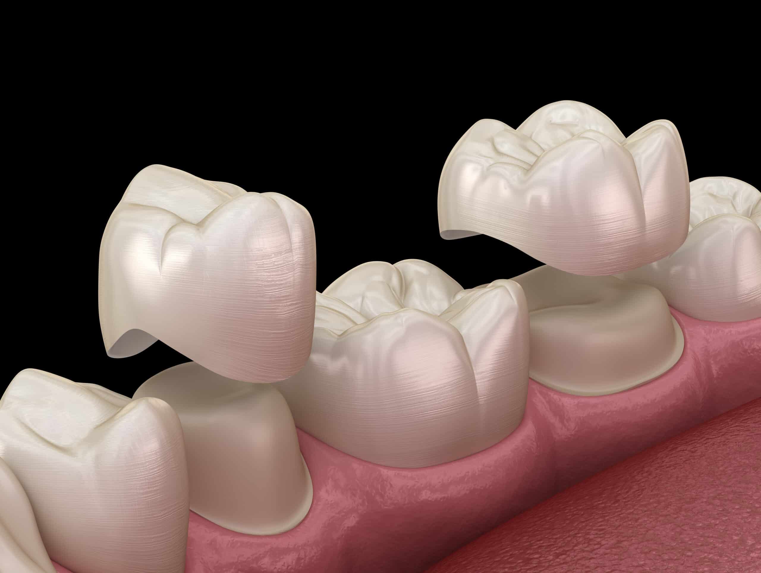 Porcelain crowns placement over premolar and molar teeth