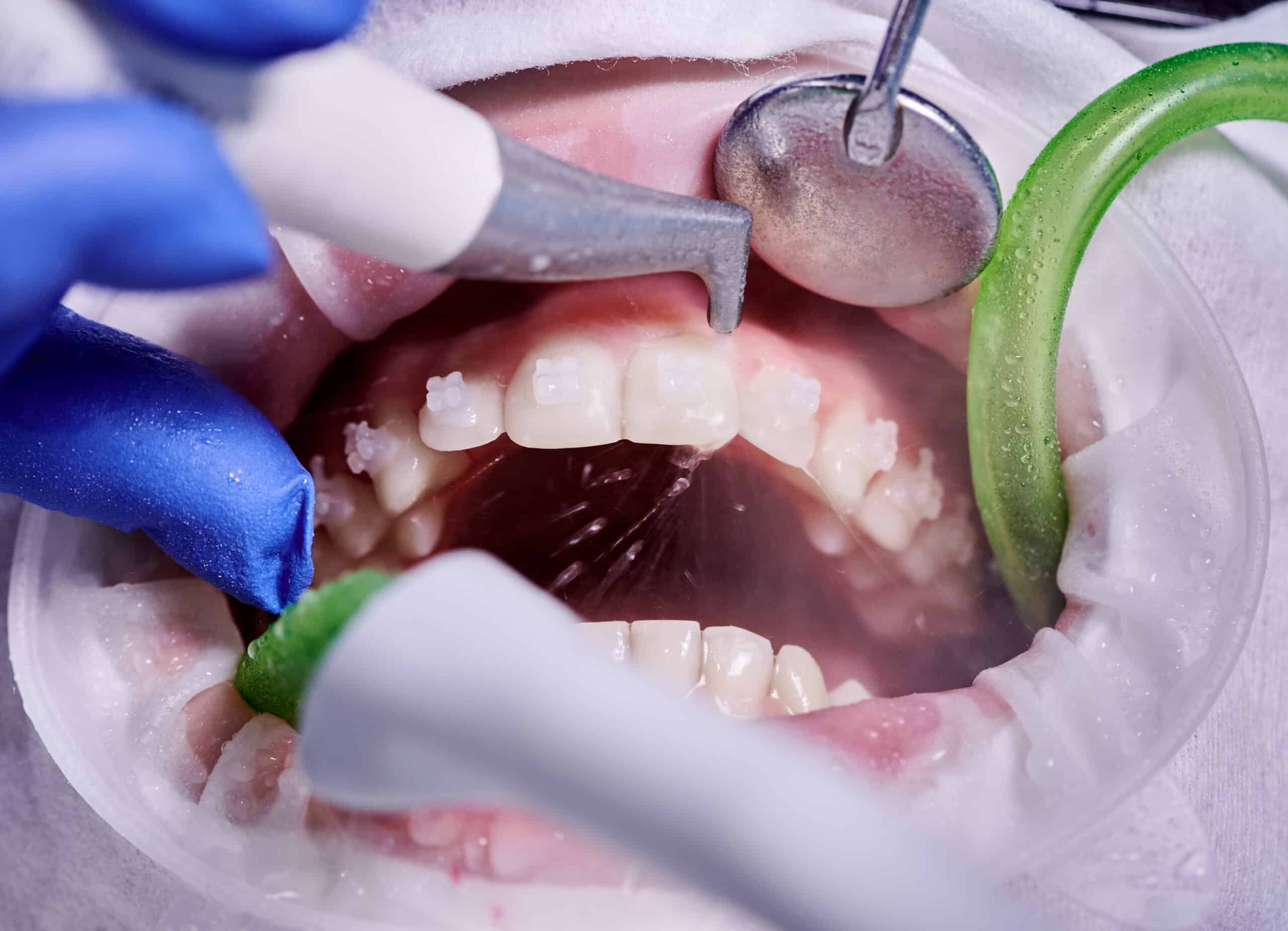  Cleaning process in patient's mouth with cheek retractor and brackets on teeth