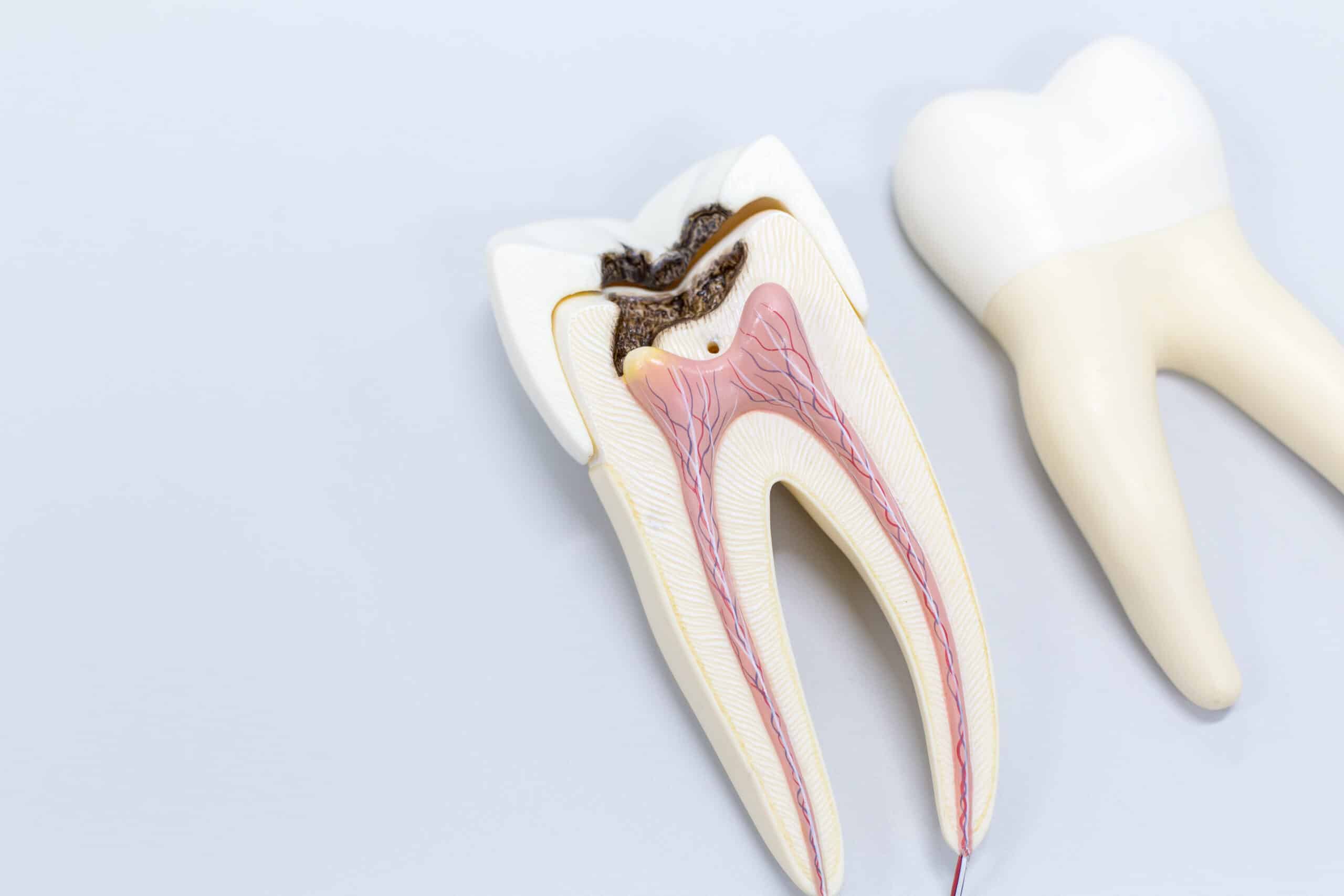 Expert Opinions on the Necessity of Root Canals